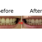 自宅で出来る歯のホワイトニングで着色汚れ・ステインも綺麗に